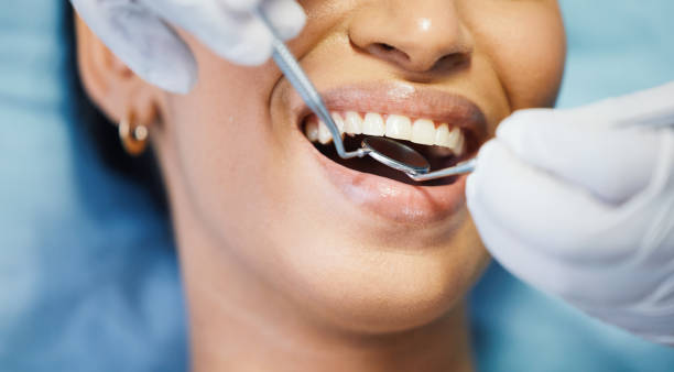 Best Emergency Wisdom Tooth Extraction in Linln Park, CO